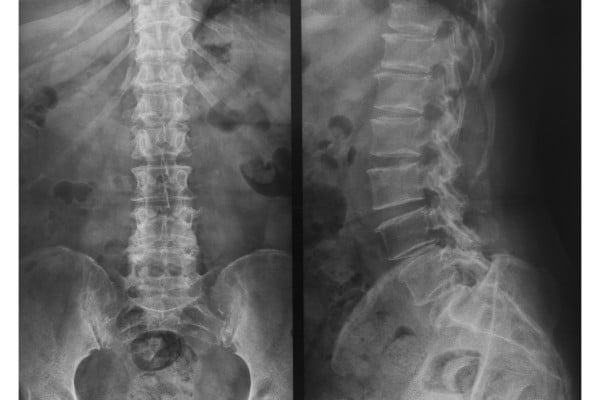 Spine Injury, Central Valley