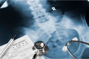 Pelvic Fractures in Traffic Accidents