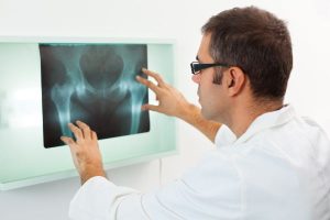 Common Types of Hip Fractures